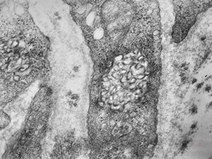 M, 3y. | lipofuscinosis M, 3y. | lipofuscinosis
